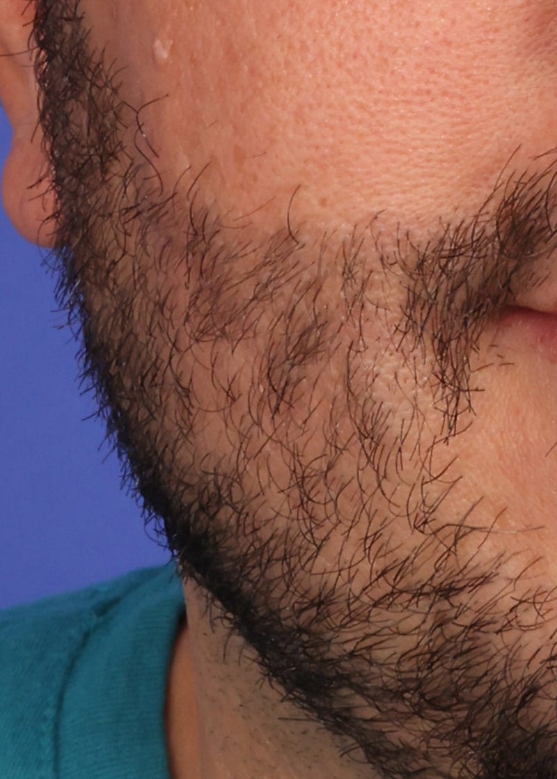 Hair Transplant Before & After Image