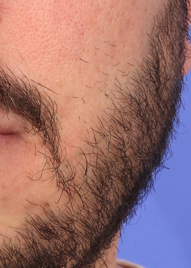 Hair Transplant Before & After Image