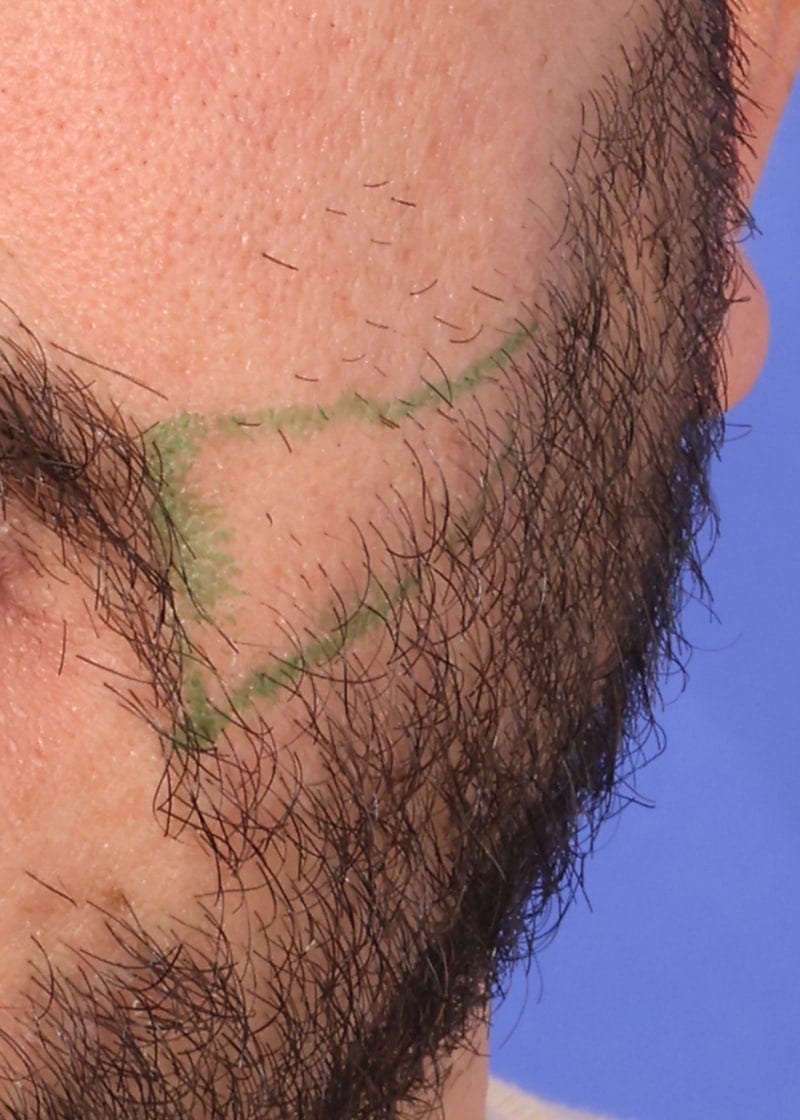 Hair Transplant Before & After Image