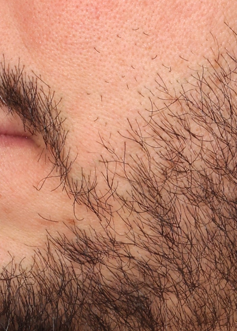 Hair Transplant Before & After Image