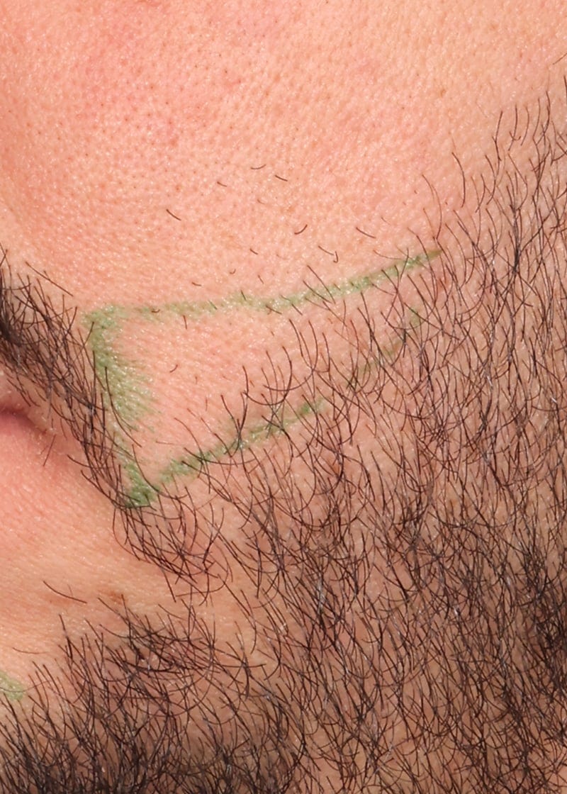 Hair Transplant Before & After Image