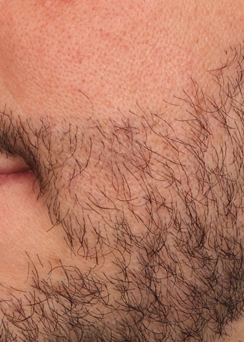 Hair Transplant Before & After Image