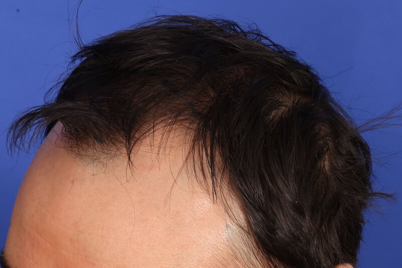 Hair Transplant Before & After Image