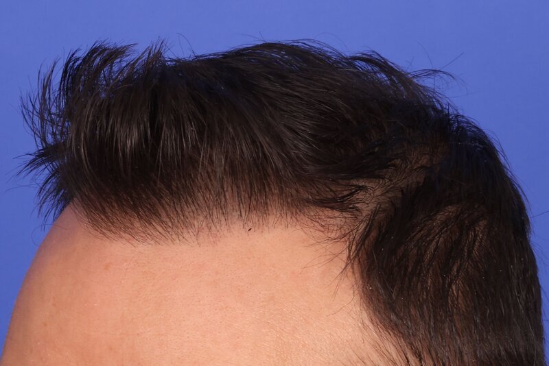 Hair Transplant Before & After Image