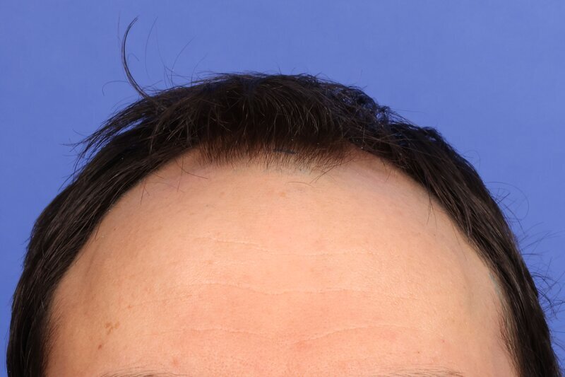 Hair Transplant Before & After Image
