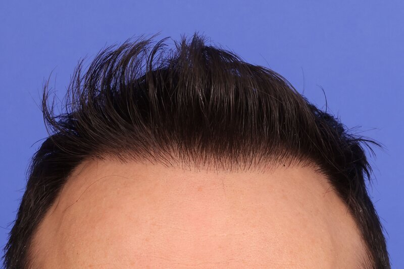 Hair Transplant Before & After Image
