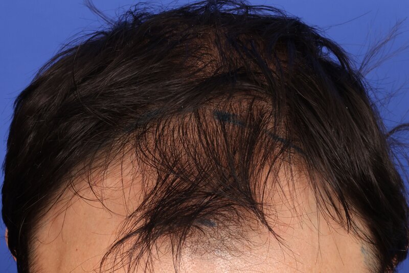 Hair Transplant Before & After Image
