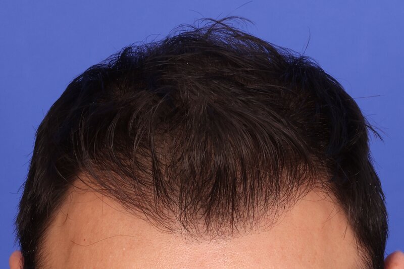 Hair Transplant Before & After Image