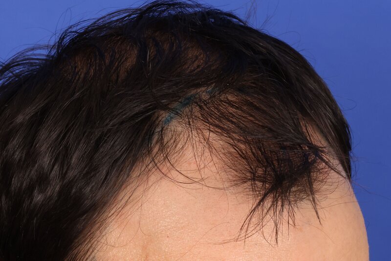 Hair Transplant Before & After Image