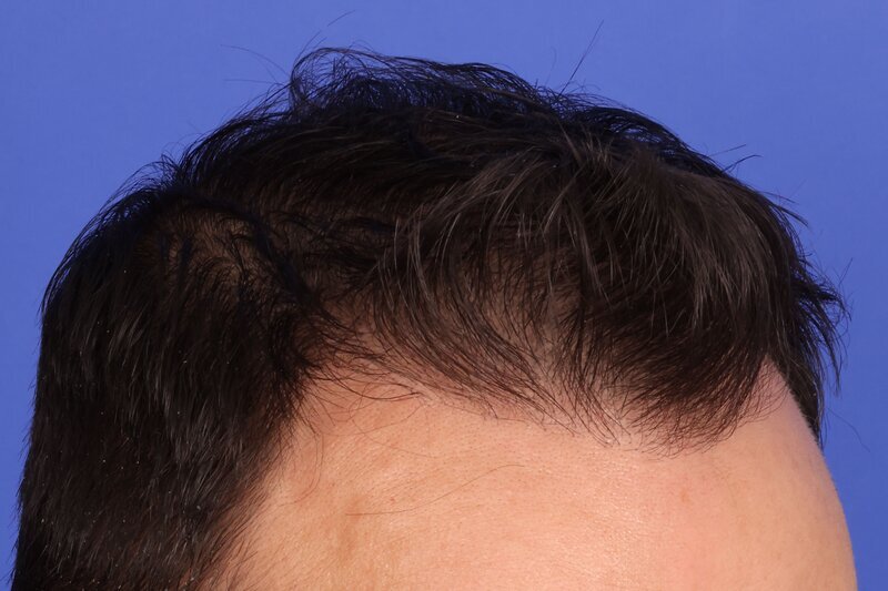 Hair Transplant Before & After Image