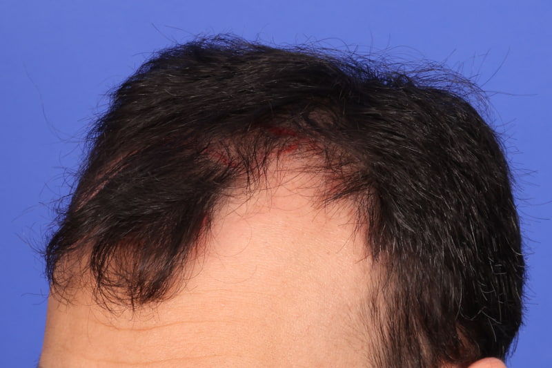 Hair Transplant Before & After Image