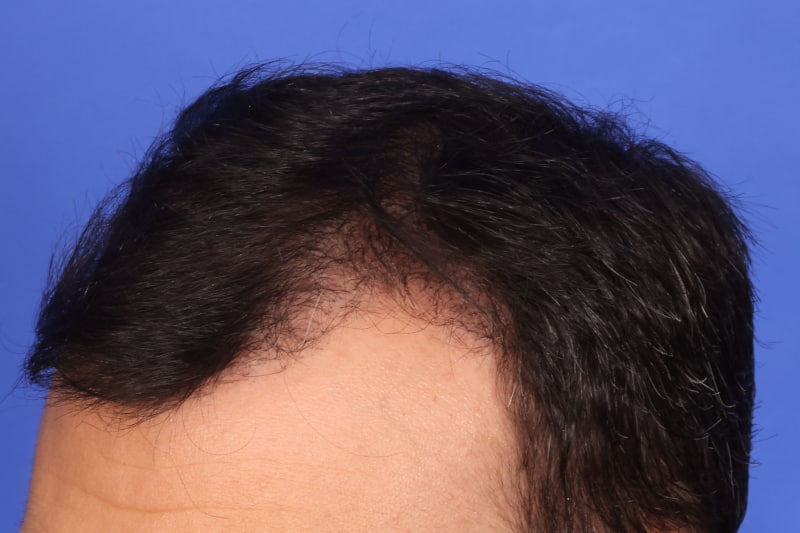 Hair Transplant Before & After Image