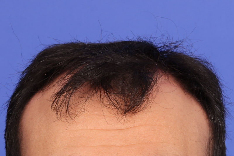 Hair Transplant Before & After Image