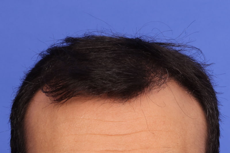 Hair Transplant Before & After Image