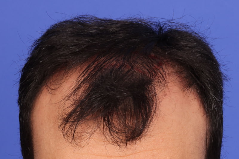 Hair Transplant Before & After Image