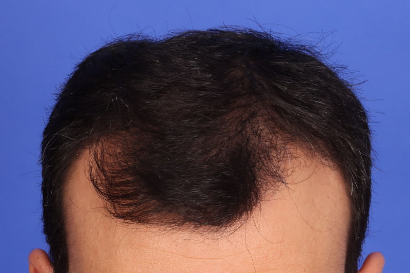 Hair Transplant Before & After Image