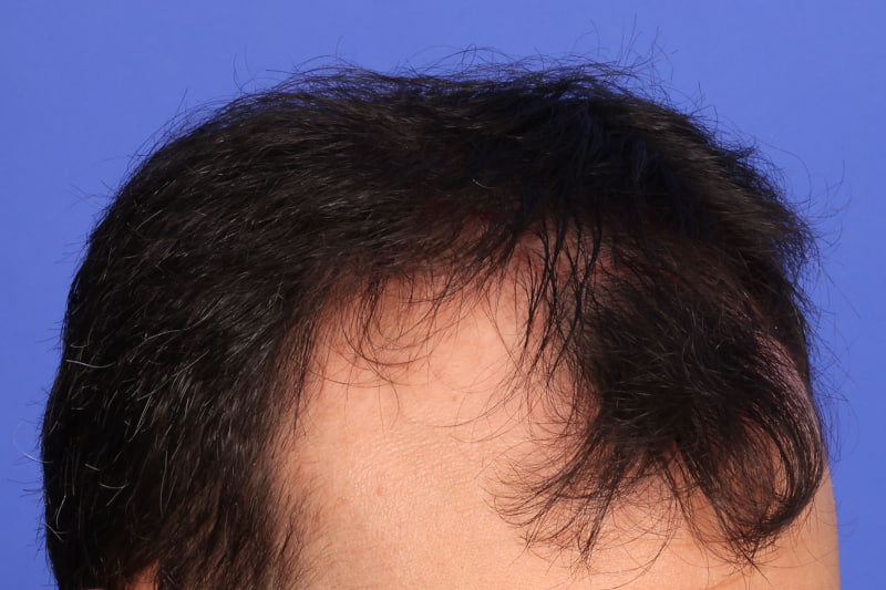 Hair Transplant Before & After Image