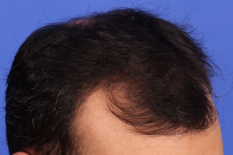 Hair Transplant Before & After Image