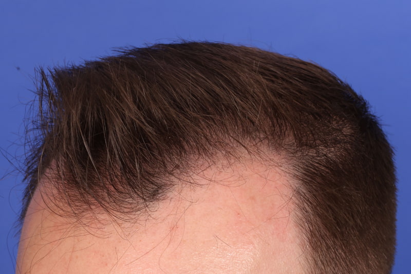 Hair Transplant Before & After Image