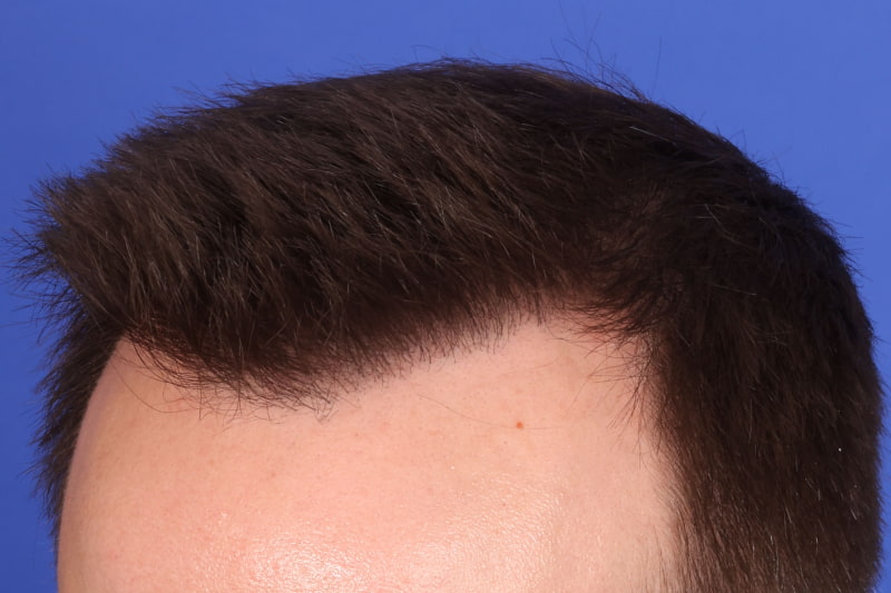 Hair Transplant Before & After Image