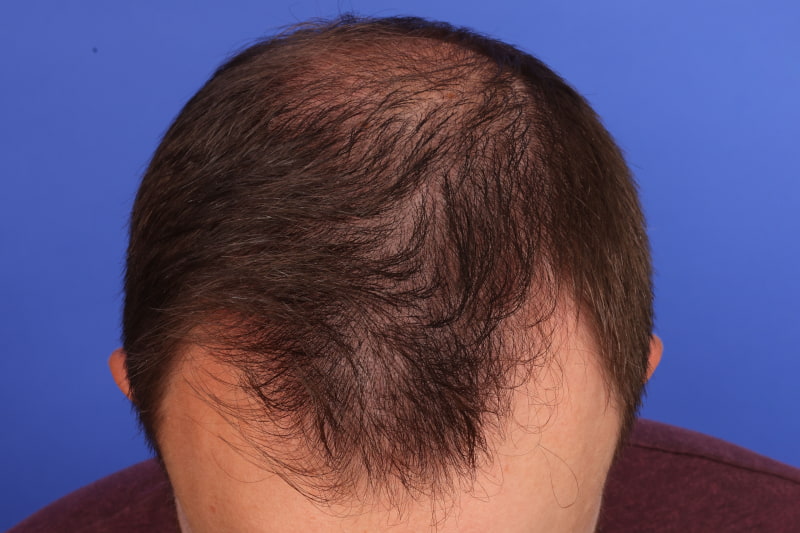 Hair Transplant Before & After Image