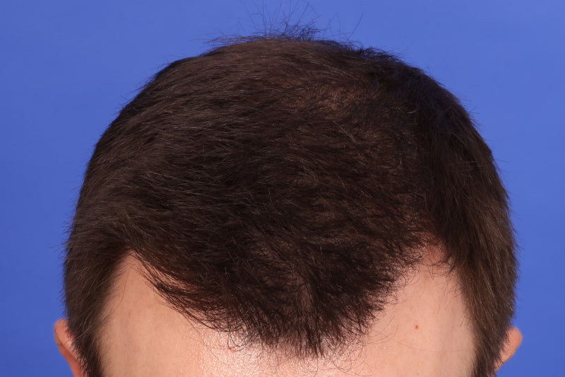 Hair Transplant Before & After Image