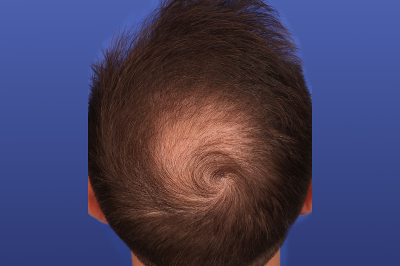 Hair Transplant Before & After Image