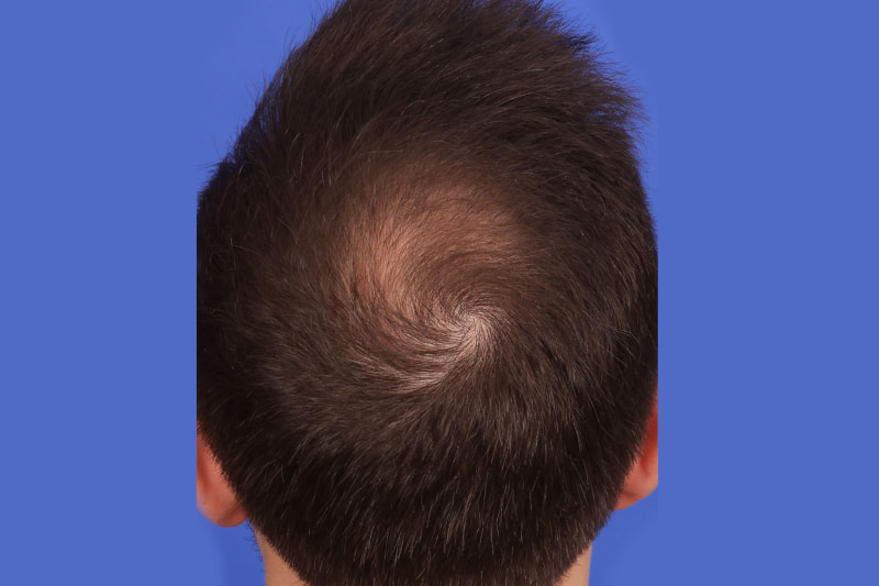 Hair Transplant Before & After Image