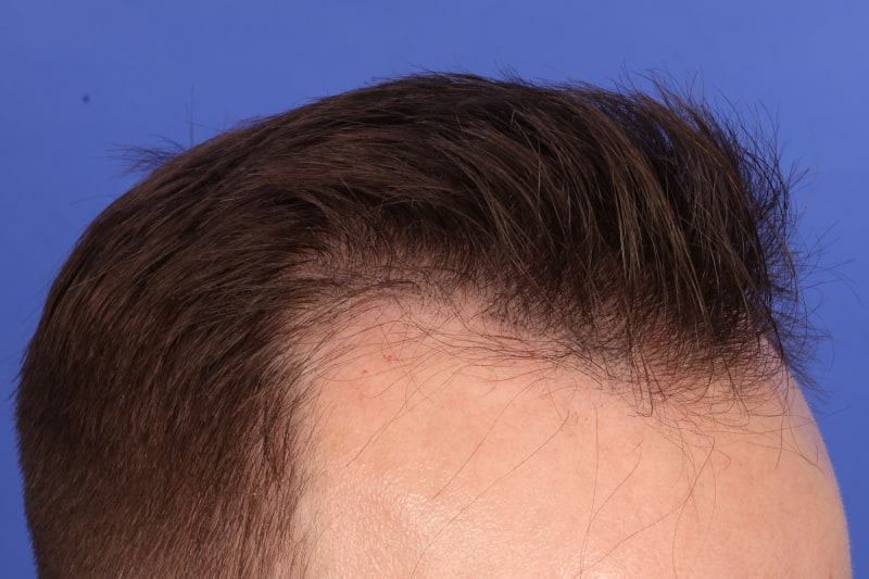 Hair Transplant Before & After Image