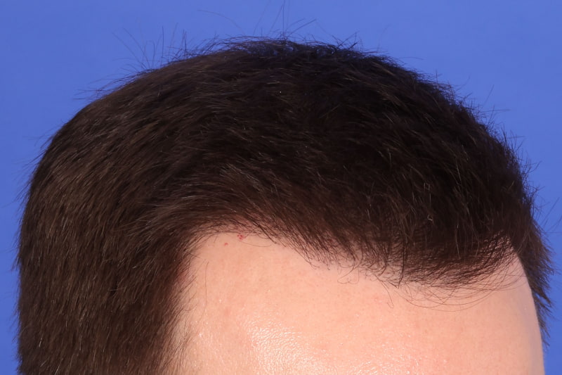 Hair Transplant Before & After Image