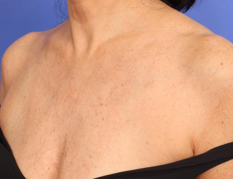 Laser Skin Resurfacing Before & After Image