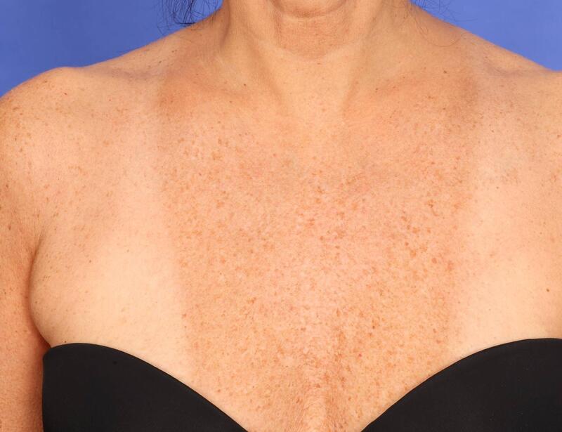 Laser Skin Resurfacing Before & After Image