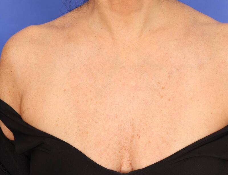 Laser Skin Resurfacing Before & After Image