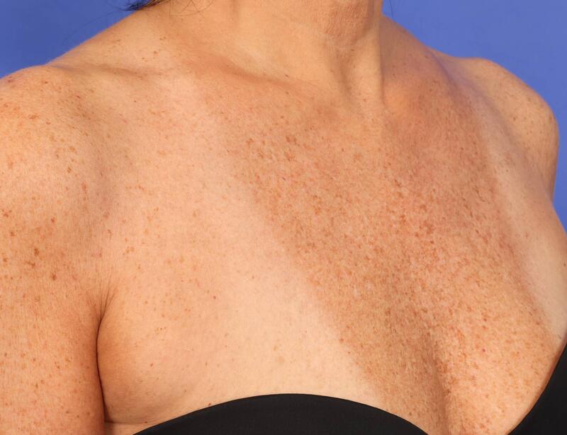Laser Skin Resurfacing Before & After Image