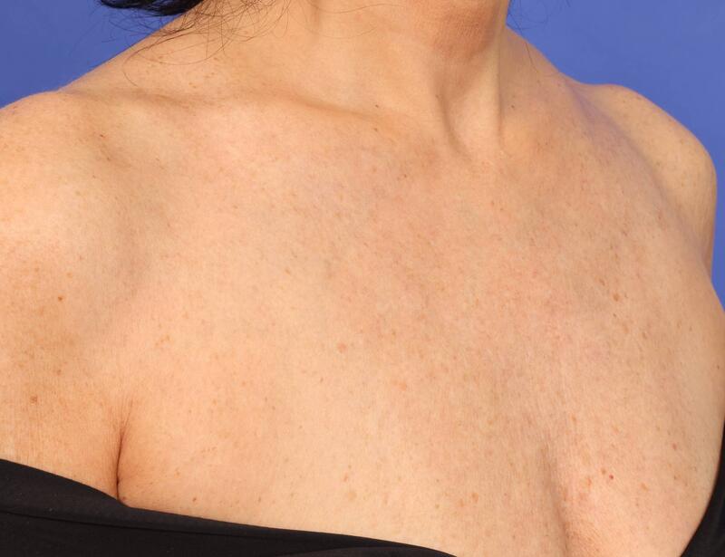 Laser Skin Resurfacing Before & After Image