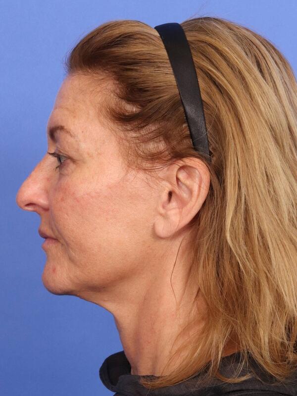 Laser Skin Resurfacing Before & After Image