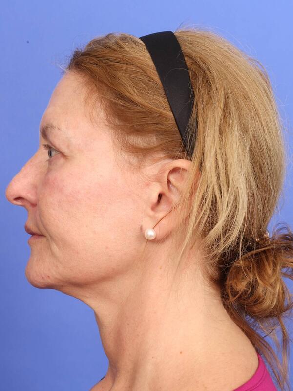 Laser Skin Resurfacing Before & After Image