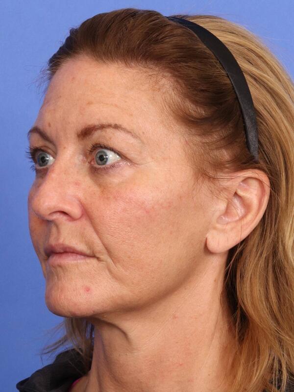 Laser Skin Resurfacing Before & After Image