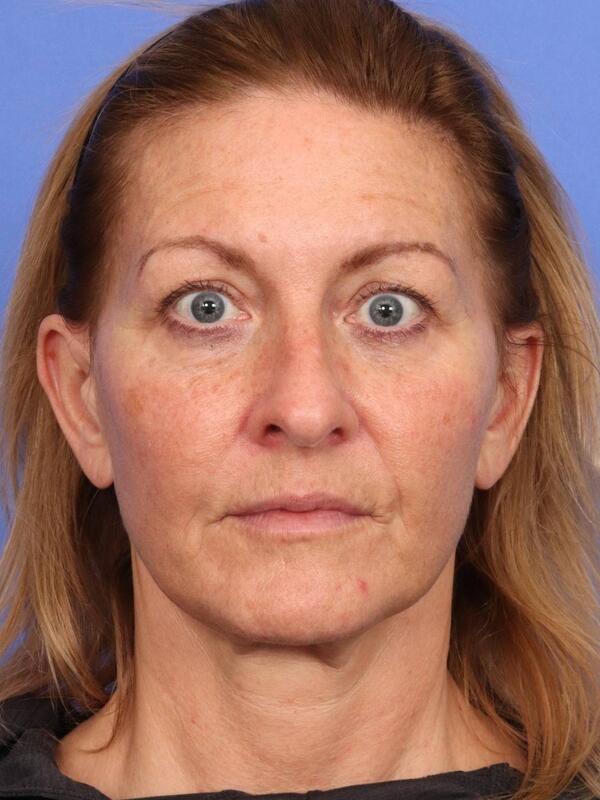 Laser Skin Resurfacing Before & After Image