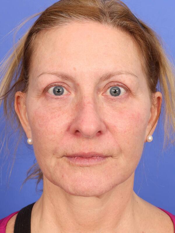 Laser Skin Resurfacing Before & After Image