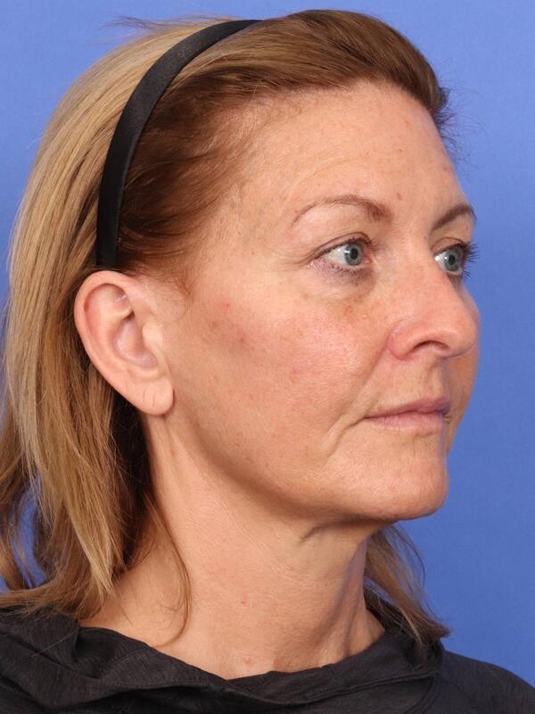Laser Skin Resurfacing Before & After Image