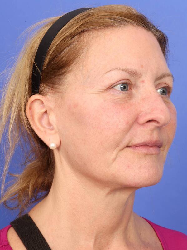Laser Skin Resurfacing Before & After Image