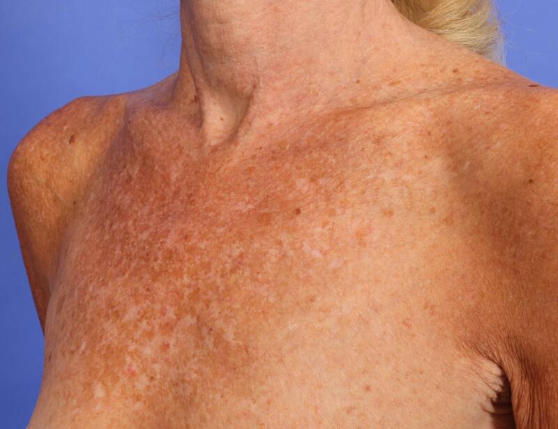 Laser Skin Resurfacing Before & After Image