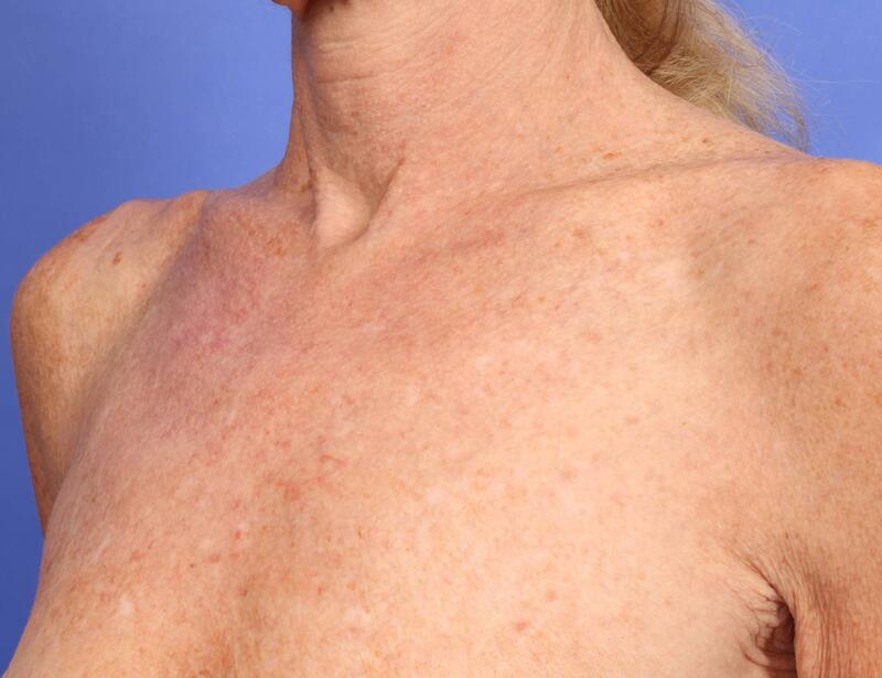 Laser Skin Resurfacing Before & After Image