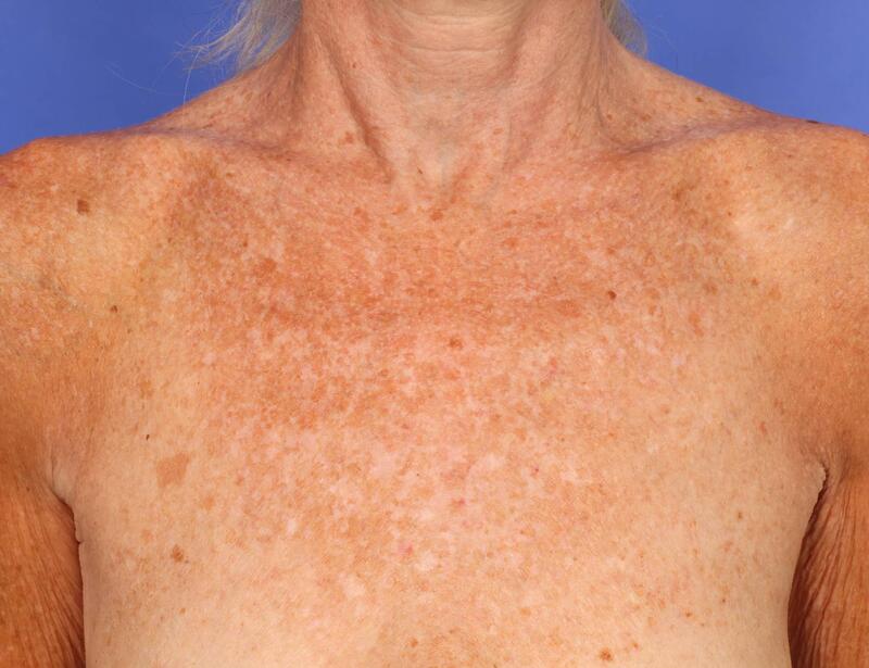 Laser Skin Resurfacing Before & After Image