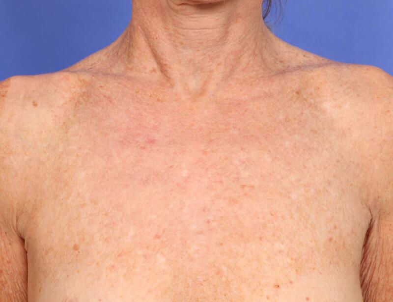 Laser Skin Resurfacing Before & After Image