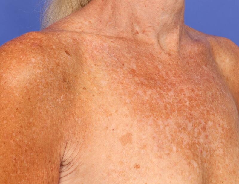 Laser Skin Resurfacing Before & After Image