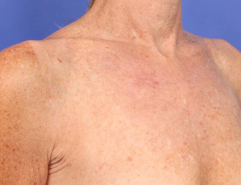 Laser Skin Resurfacing Before & After Image