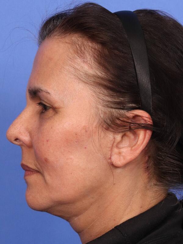 Laser Skin Resurfacing Before & After Image