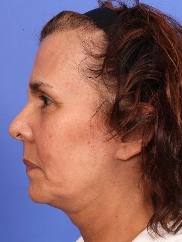 Laser Skin Resurfacing Before & After Image